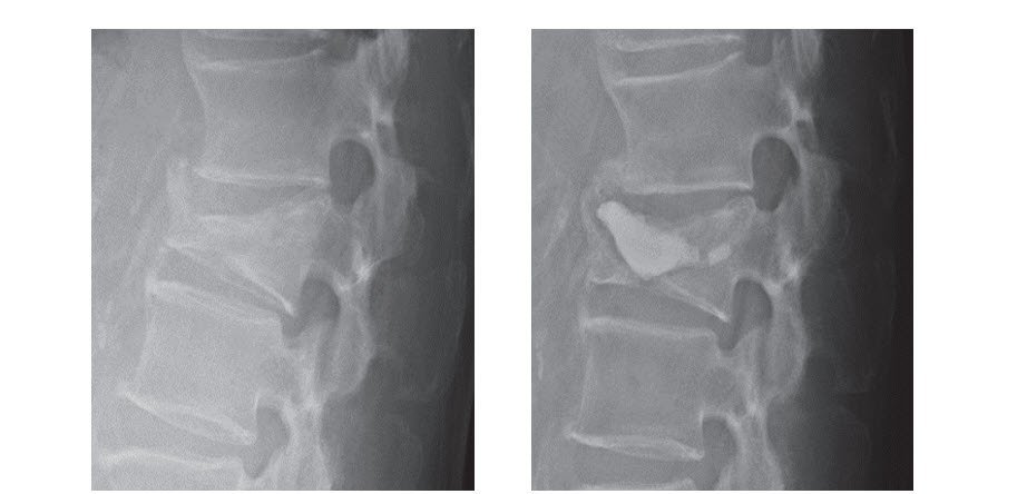 Two X-rays side by side showing a vertebral compression fracture before and after balloon kyphoplasty, with injected cement visible in the second image.