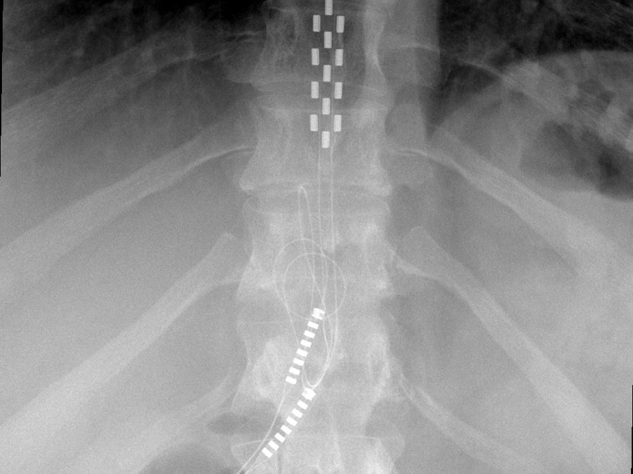 X-ray showing an implanted spinal cord stimulator, with two electrode arrays and a lead visible along the spine.